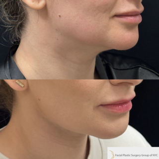 ET-33-y.o-female-who-is-3-months-out-from-Chin-and-Neck-Liposculpting-with-Skin-Tightening-and-Buccal-Fat-Reduction-1-1