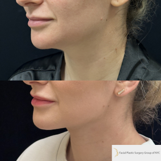 ET-33-y.o-female-who-is-3-months-out-from-Chin-and-Neck-Liposculpting-with-Skin-Tightening-and-Buccal-Fat-Reduction-1-2
