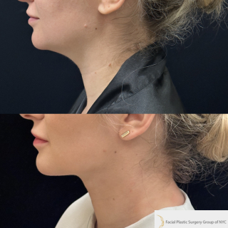 ET-33-y.o-female-who-is-3-months-out-from-Chin-and-Neck-Liposculpting-with-Skin-Tightening-and-Buccal-Fat-Reduction-1-3