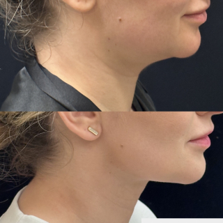 ET-33-y.o-female-who-is-3-months-out-from-Chin-and-Neck-Liposculpting-with-Skin-Tightening-and-Buccal-Fat-Reduction-1-4