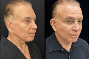 75-y.o-male-Deep-Plane-Facelift-and-Necklift.-He-is-now-4-months-out-from-the-surgery-1-1