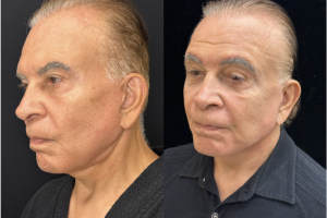 75-y.o-male-Deep-Plane-Facelift-and-Necklift.-He-is-now-4-months-out-from-the-surgery-1-2