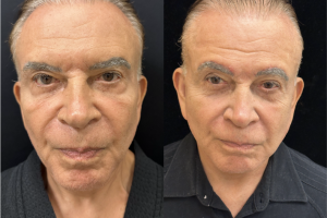 75-y.o-male-Deep-Plane-Facelift-and-Necklift.-He-is-now-4-months-out-from-the-surgery-1-3
