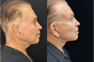 75-y.o-male-Deep-Plane-Facelift-and-Necklift.-He-is-now-4-months-out-from-the-surgery-1-4