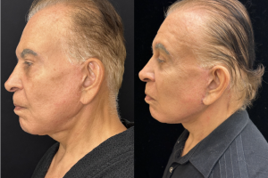 75-y.o-male-Deep-Plane-Facelift-and-Necklift.-He-is-now-4-months-out-from-the-surgery-1-5