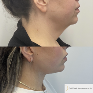 39-y.o-female-awake-Deep-Plane-facelift-and-Necklift-1-1