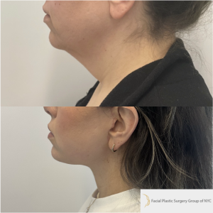 39-y.o-female-awake-Deep-Plane-facelift-and-Necklift-1-2