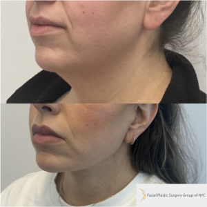 39-y.o-female-awake-Deep-Plane-facelift-and-Necklift-1-3
