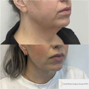 39-y.o-female-awake-Deep-Plane-facelift-and-Necklift-1-4