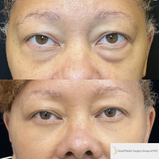 AH-49-y.o-female-who-is-6-months-out-from-transconjuctival-lower-blepharoplasty-and-facial-fat-transfer-1-1