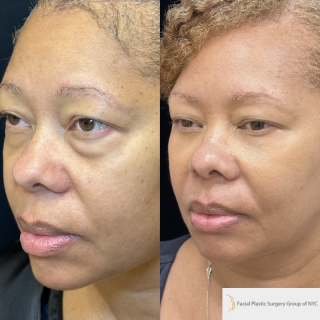 AH-49-y.o-female-who-is-6-months-out-from-transconjuctival-lower-blepharoplasty-and-facial-fat-transfer-1-2