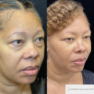 AH-49-y.o-female-who-is-6-months-out-from-transconjuctival-lower-blepharoplasty-and-facial-fat-transfer-1-3