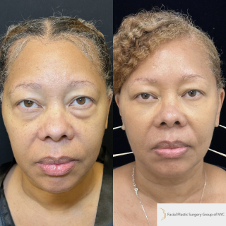AH-49-y.o-female-who-is-6-months-out-from-transconjuctival-lower-blepharoplasty-and-facial-fat-transfer-1-4