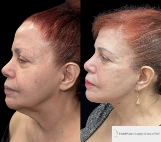 CS-71-y.o-who-is-6-months-out-from-Deep-Plane-Facelift-and-Necklift-1-1