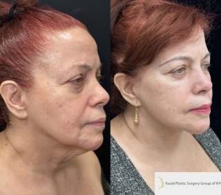 CS-71-y.o-who-is-6-months-out-from-Deep-Plane-Facelift-and-Necklift-1-2
