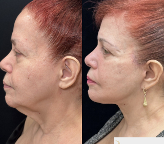 CS-71-y.o-who-is-6-months-out-from-Deep-Plane-Facelift-and-Necklift-1-3