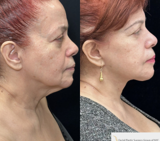 CS-71-y.o-who-is-6-months-out-from-Deep-Plane-Facelift-and-Necklift-1-4