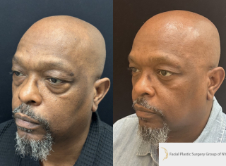 EG-54-y.o-male-who-is-3-months-out-from-transconjuctival-lower-Blepharoplasty-1-1