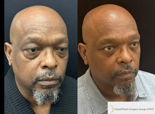 EG-54-y.o-male-who-is-3-months-out-from-transconjuctival-lower-Blepharoplasty-1-2
