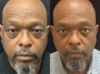 EG-54-y.o-male-who-is-3-months-out-from-transconjuctival-lower-Blepharoplasty-1-3