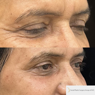GS-62-y.o-patient-who-is-6-months-out-from-upper-blepharoplasty-1-1