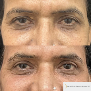 GS-62-y.o-patient-who-is-6-months-out-from-upper-blepharoplasty-1-2