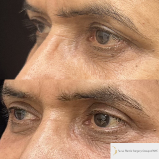 GS-62-y.o-patient-who-is-6-months-out-from-upper-blepharoplasty-1-3