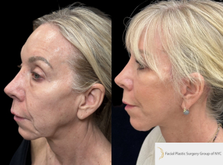 LF-61-y.o-female-who-is-3-months-out-from-Deep-Plane-Facelift-Necklift-and-Lower-Blepharoplasty1-1
