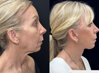 LF-61-y.o-female-who-is-3-months-out-from-Deep-Plane-Facelift-Necklift-and-Lower-Blepharoplasty1-2