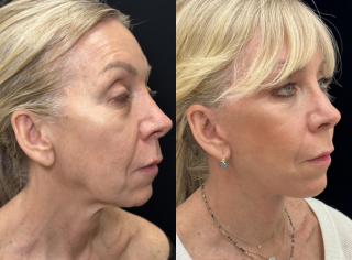 LF-61-y.o-female-who-is-3-months-out-from-Deep-Plane-Facelift-Necklift-and-Lower-Blepharoplasty1-3
