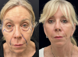 LF-61-y.o-female-who-is-3-months-out-from-Deep-Plane-Facelift-Necklift-and-Lower-Blepharoplasty1-4