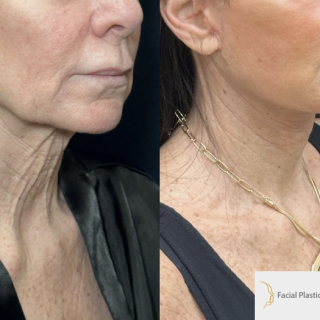 LJ-61-y.o-female-who-is-3-months-out-from-Deep-Plane-Facelift-Necklift-and-Facial-Fat-Transfer-and-CO2-laser-resurfacing-1-1