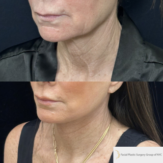 LJ-61-y.o-female-who-is-3-months-out-from-Deep-Plane-Facelift-Necklift-and-Facial-Fat-Transfer-and-CO2-laser-resurfacing-1-2
