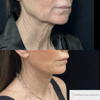 LJ-61-y.o-female-who-is-3-months-out-from-Deep-Plane-Facelift-Necklift-and-Facial-Fat-Transfer-and-CO2-laser-resurfacing-1-3