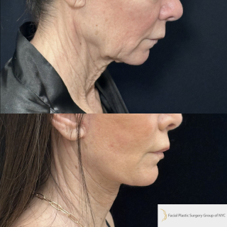 LJ-61-y.o-female-who-is-3-months-out-from-Deep-Plane-Facelift-Necklift-and-Facial-Fat-Transfer-and-CO2-laser-resurfacing-1-5