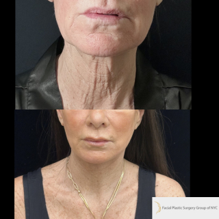 LJ-61-y.o-female-who-is-3-months-out-from-Deep-Plane-Facelift-Necklift-and-Facial-Fat-Transfer-and-CO2-laser-resurfacing-1-6
