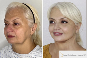 Deep-Plane-Facelift-Extended-Deep-plane-Neck-Lift-Lower-Blepharoplasty-and-CO2-laser-to-face-2