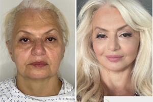 Deep-Plane-Facelift-Extended-Deep-plane-Neck-Lift-Lower-Blepharoplasty-and-CO2-laser-to-face-3