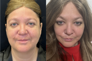 60-y.o-female-Deep-Plane-Facelift-Necklift-1-1