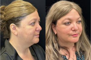 60-y.o-female-Deep-Plane-Facelift-Necklift-1-2