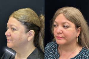 60-y.o-female-Deep-Plane-Facelift-Necklift-1-3