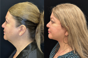 60-y.o-female-Deep-Plane-Facelift-Necklift-1-4