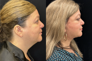 60-y.o-female-Deep-Plane-Facelift-Necklift-1-5
