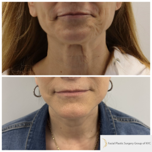 58-y.o-female-Awake-Deep-Plane-Facelift-and-Necklift-1-1