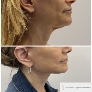 58-y.o-female-Awake-Deep-Plane-Facelift-and-Necklift-1-2