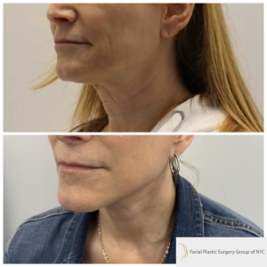 58-y.o-female-Awake-Deep-Plane-Facelift-and-Necklift-1-3