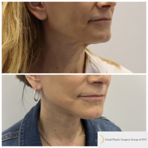 58-y.o-female-Awake-Deep-Plane-Facelift-and-Necklift-1-4