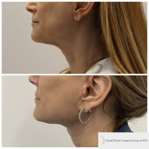 58-y.o-female-Awake-Deep-Plane-Facelift-and-Necklift-1-5