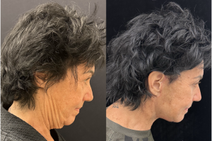 60-y.o-female-Awake-Deep-Plane-Facelift-Necklift-Upper-and-Lower-Blepharoplasty-and-Facial-Fat-Transfer-1-2