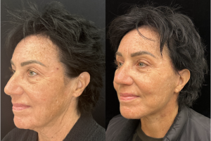 60-y.o-female-Awake-Deep-Plane-Facelift-Necklift-Upper-and-Lower-Blepharoplasty-and-Facial-Fat-Transfer-1-4
